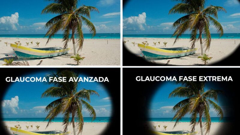 Glaucoma, el ladrón silente de la visión