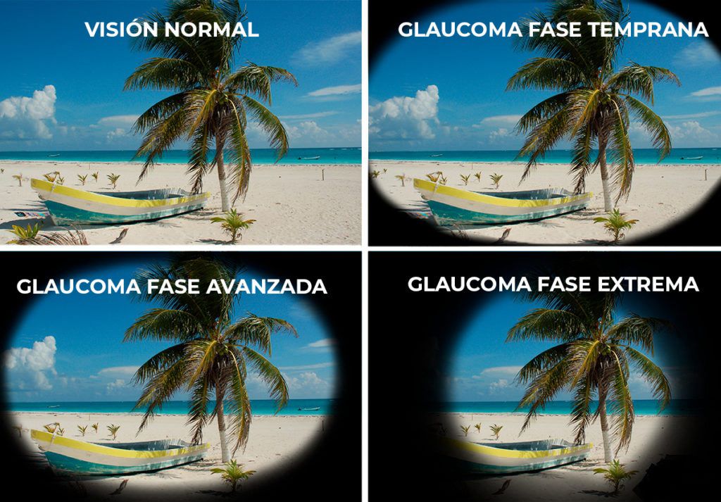 Glaucoma, el ladrón silente de la visión